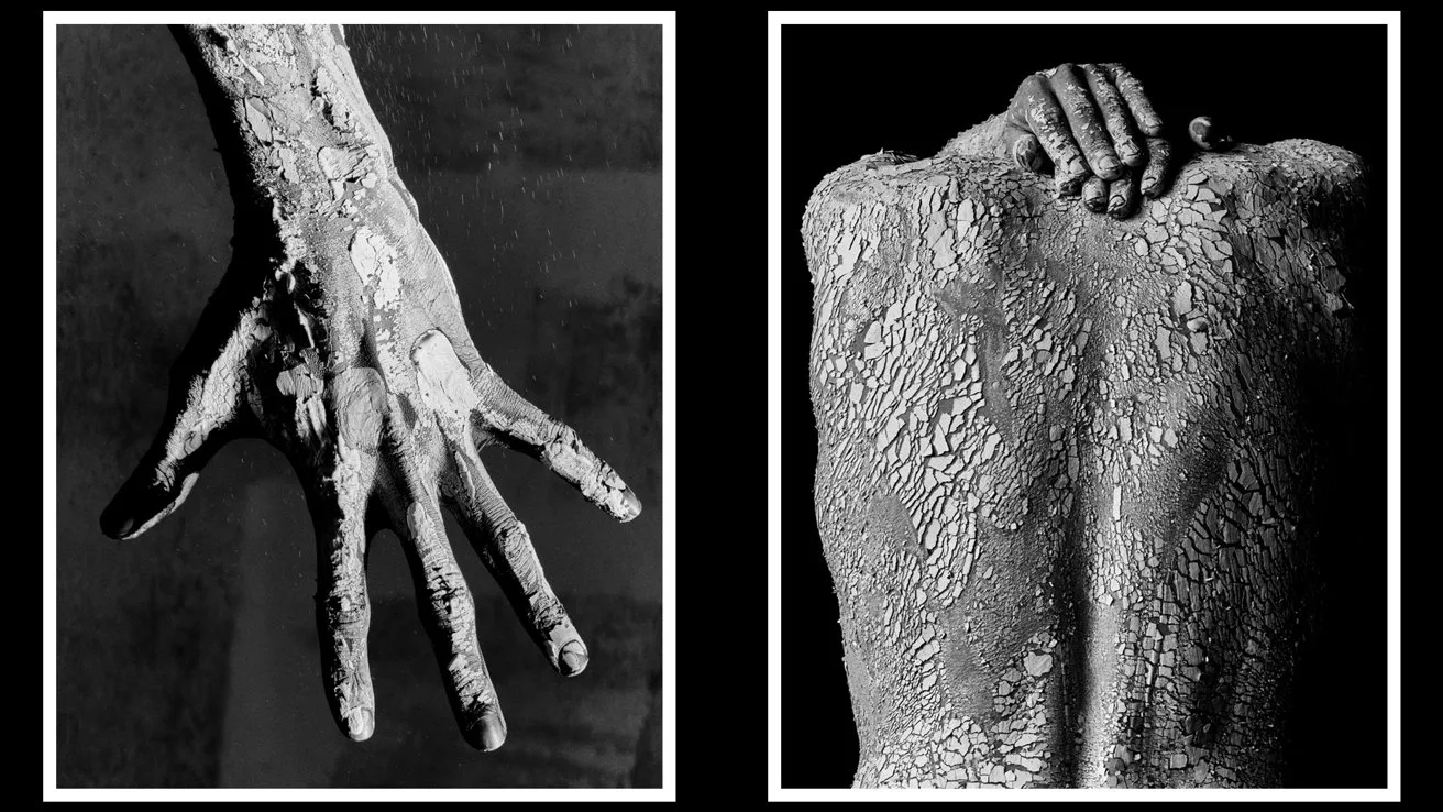 Two black-and-white panels showing a person's skin covered in thick, cracked, scaly patches: a close-up outstretched hand on the left and a bare back with one hand resting on it on the right
